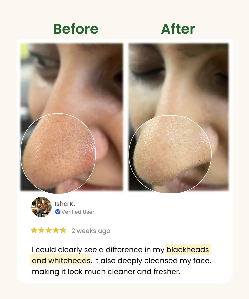 Blackheads Removal Face Pack