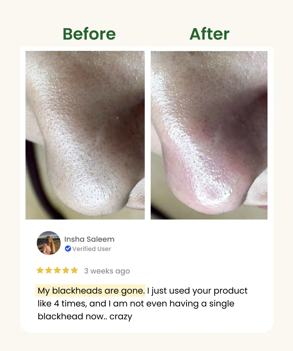 Blackheads Removal Face Pack
