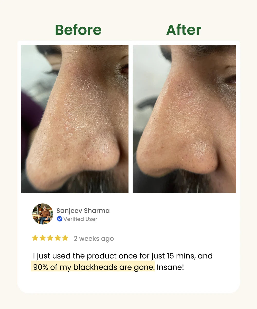 Blackheads Removal Face Pack